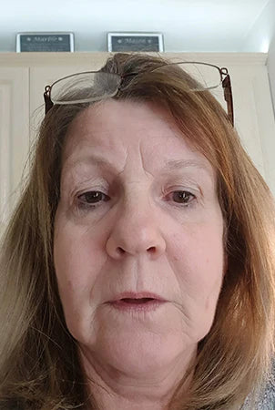 Image of Absoluter Wendy before taking Absolute Collagen's Collagen Supplement