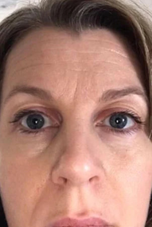 Image of Absoluter Kerrie before using Absolute Collagen's Collagen Supplement